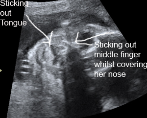 3d-ultrasound-1 3d-ultrasound-1