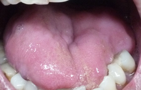 Adenoid Cystic Carcinoma