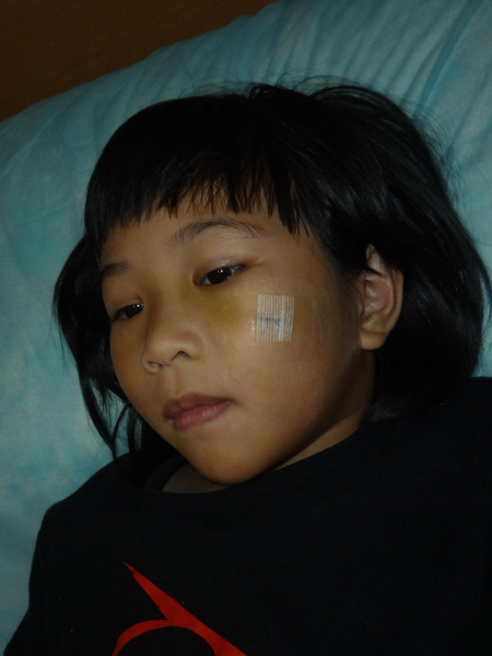 Stitches on little girl