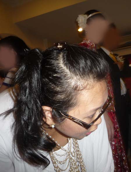Balding