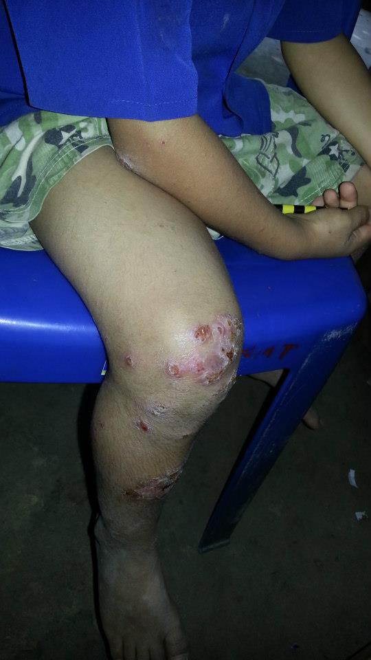 Skin Disease